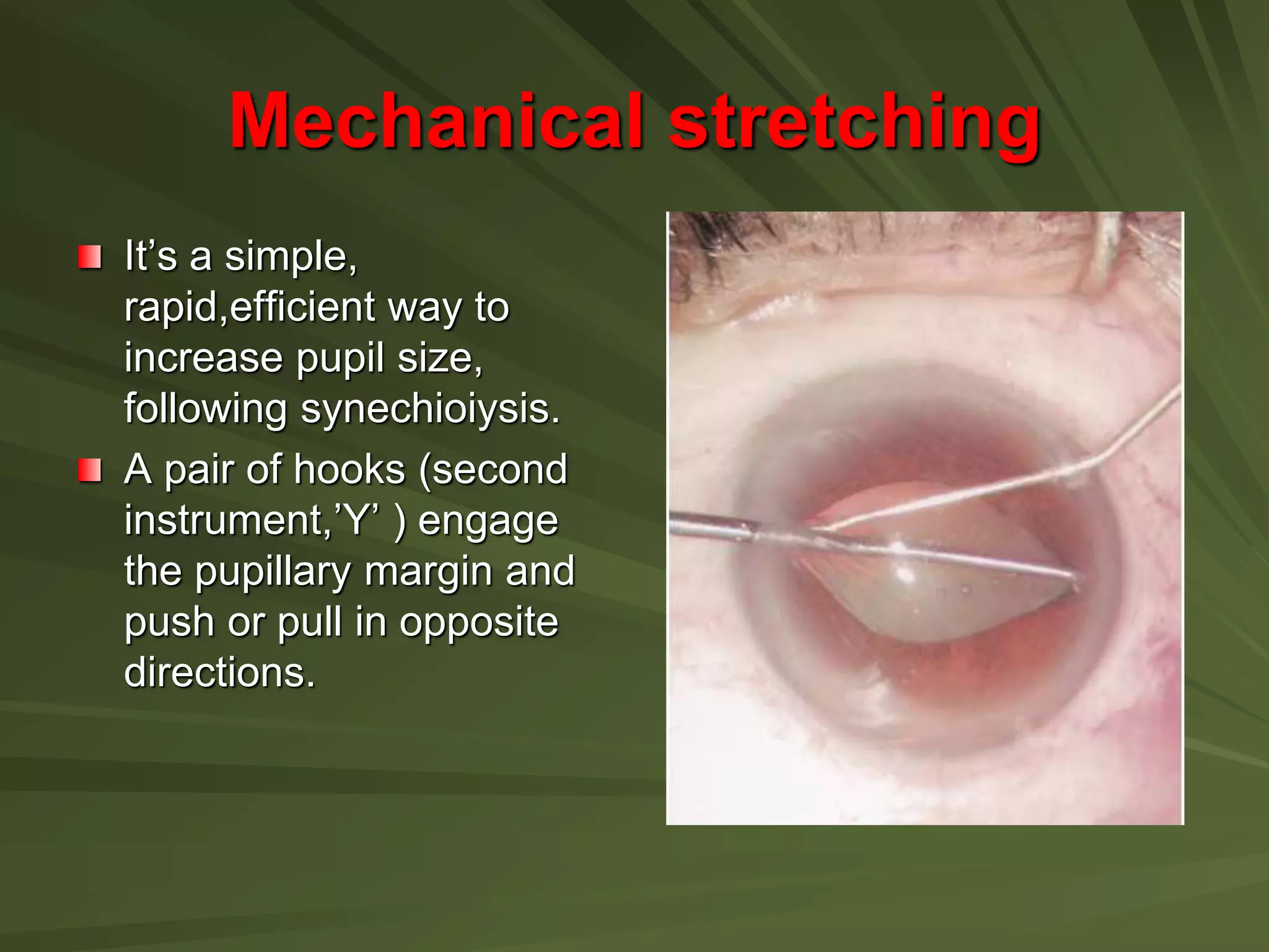 Mechanical stretching
It’s a simple,
rapid,efficient way to
increase pupil size,
following synechioiysis.
A pair of hooks (second
instrument,’Y’ ) engage
the pupillary margin and
push or pull in opposite
directions.
 