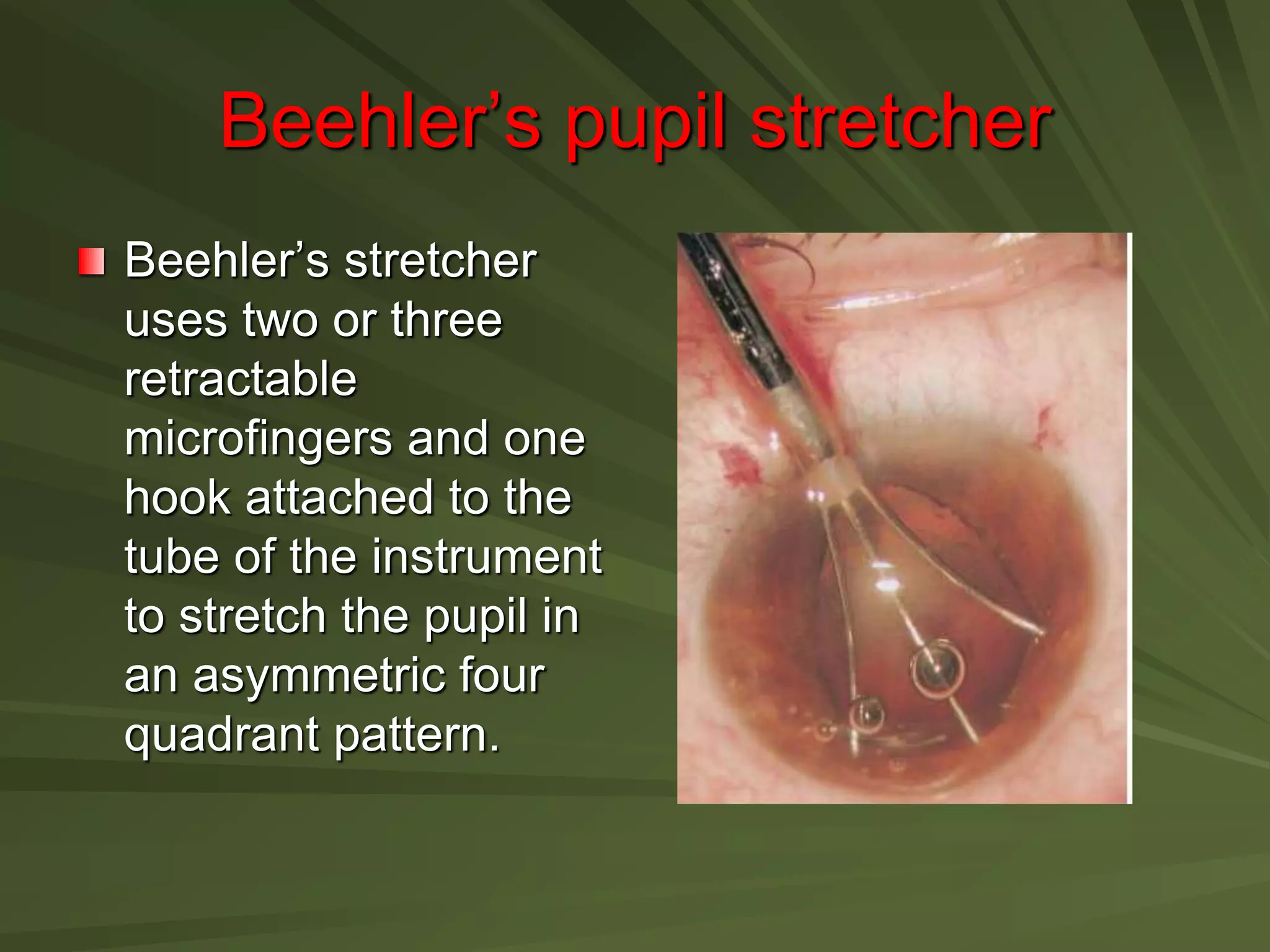 Beehler’s pupil stretcher
Beehler’s stretcher
uses two or three
retractable
microfingers and one
hook attached to the
tube of the instrument
to stretch the pupil in
an asymmetric four
quadrant pattern.
 