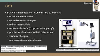 Oct And Rop Update on retinopathy of prematurity | PPTX