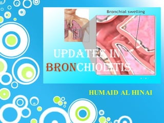 UPDATES IN  BRON CHIOLITIS HUMAID AL HINAI 