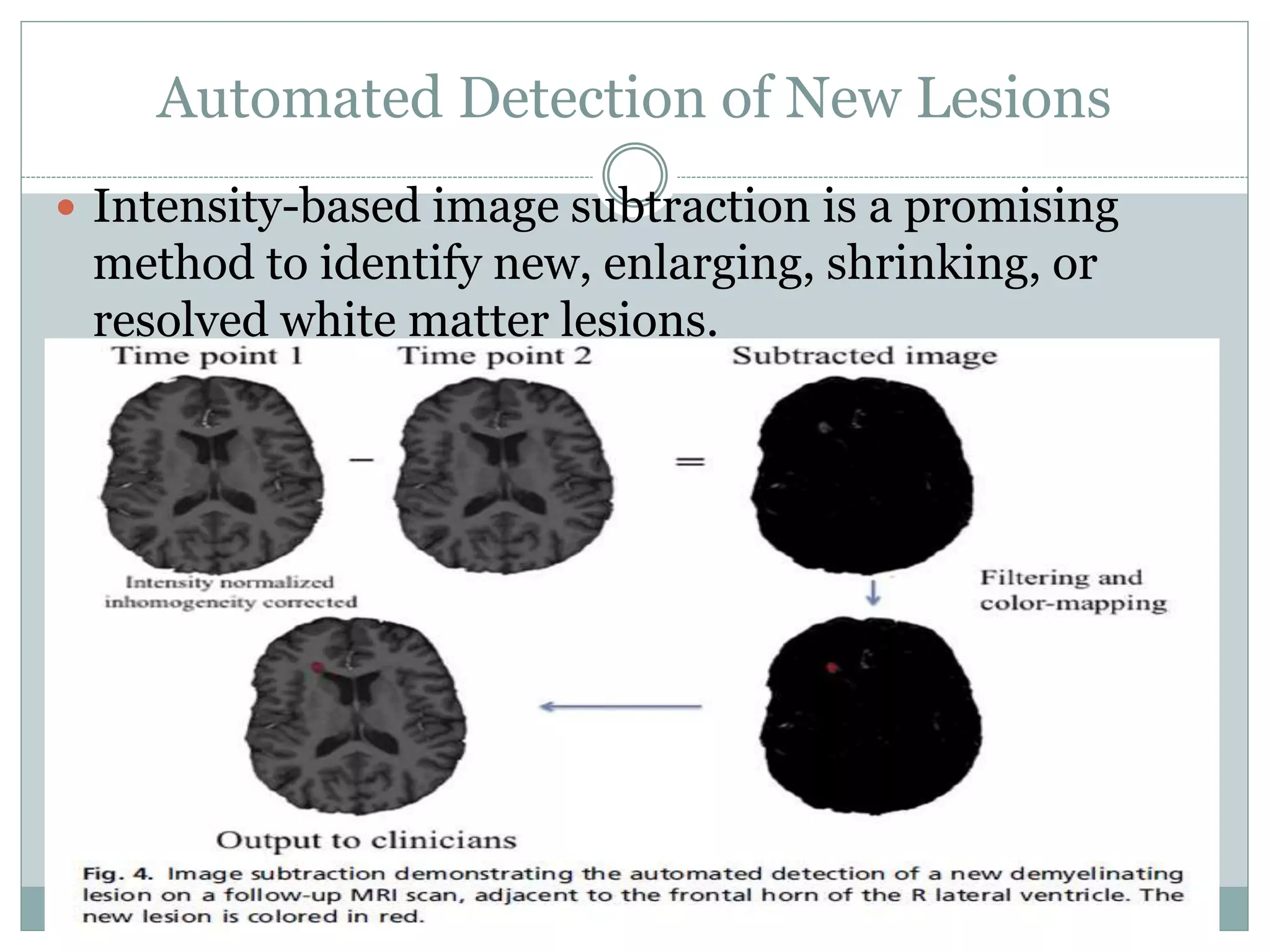 Automated Detection of New Lesions
 Intensity-based image subtraction is a promising
method to identify new, enlarging, shrinking, or
resolved white matter lesions.
 