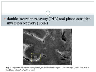  double inversion recovery (DIR) and phase-sensitive
inversion recovery (PSIR)
 