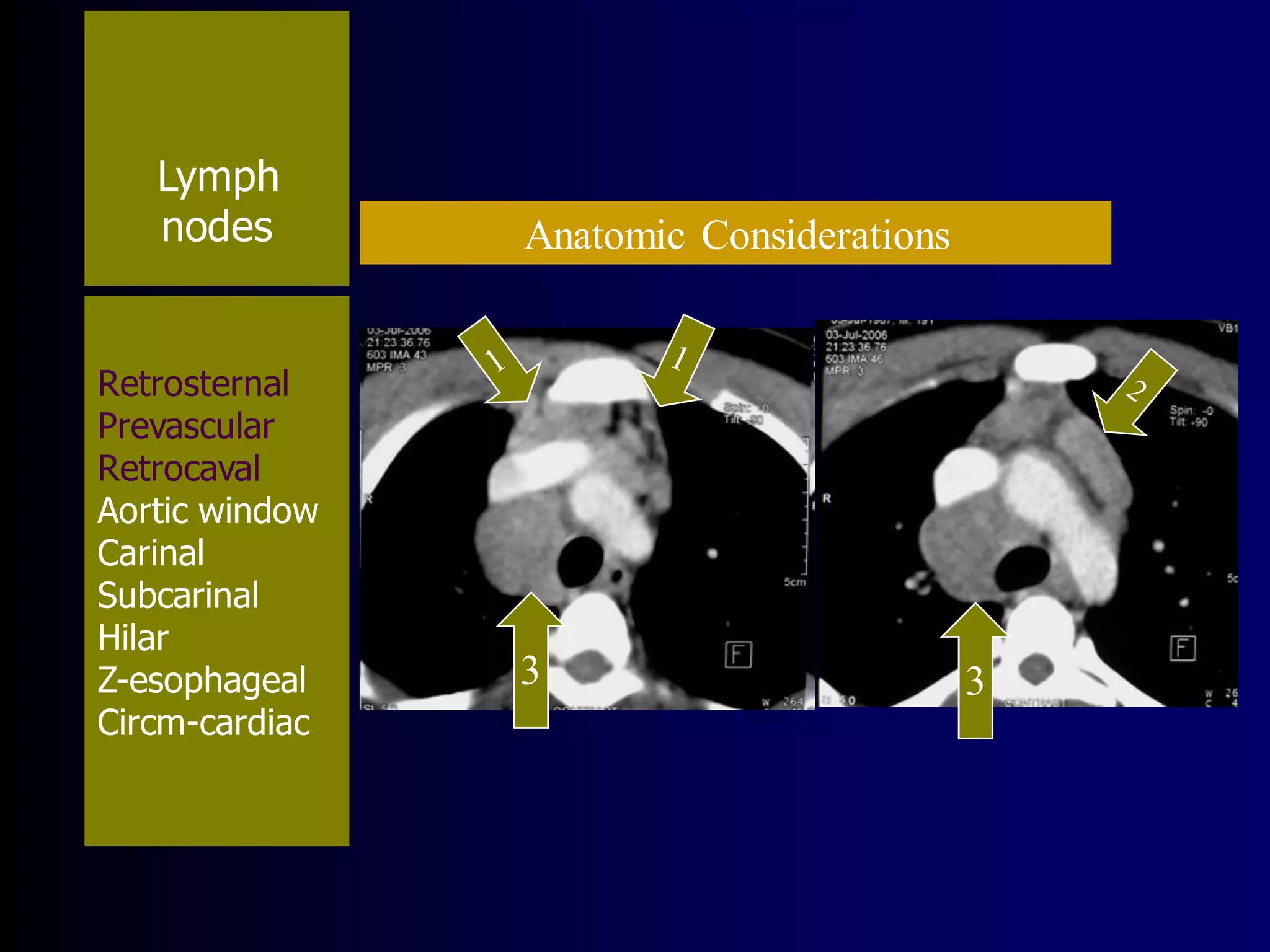 Lymph
nodes

Retrosternal
Prevascular
Retrocaval
Aortic window
Carinal
Subcarinal
Hilar
Z-esophageal
Circm-cardiac

Anatomic Considerations

3

3

 