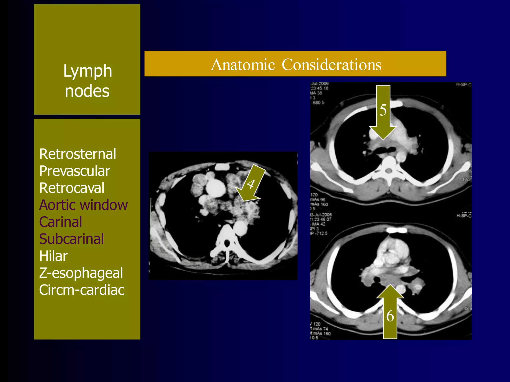 Lymph
nodes

Anatomic Considerations
5

Retrosternal
Prevascular
Retrocaval
Aortic window
Carinal
Subcarinal
Hilar
Z-esophageal
Circm-cardiac

6

 