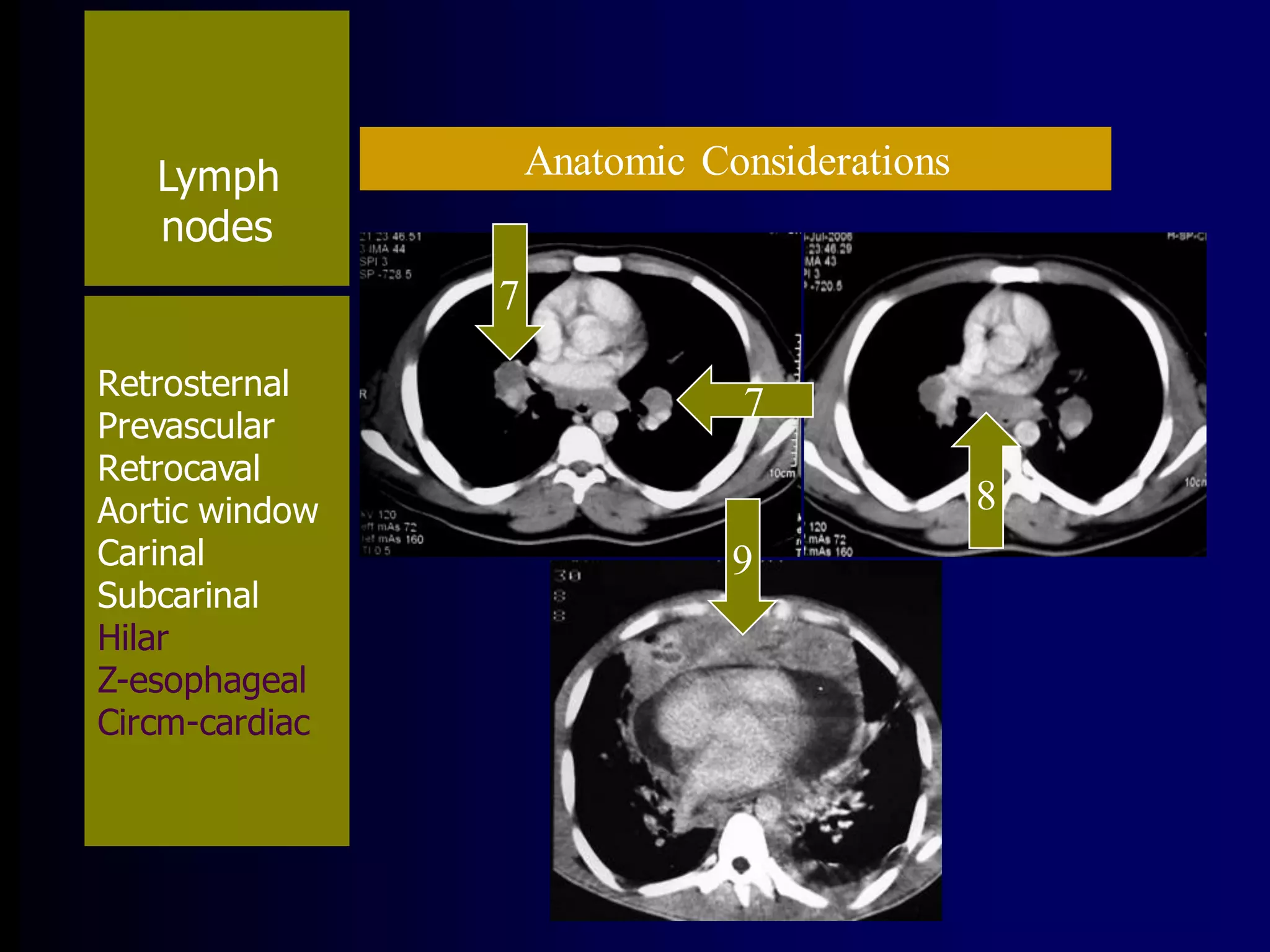 Anatomic Considerations

Lymph
nodes
7
Retrosternal
Prevascular
Retrocaval
Aortic window
Carinal
Subcarinal
Hilar
Z-esophageal
Circm-cardiac

7
8

9

 