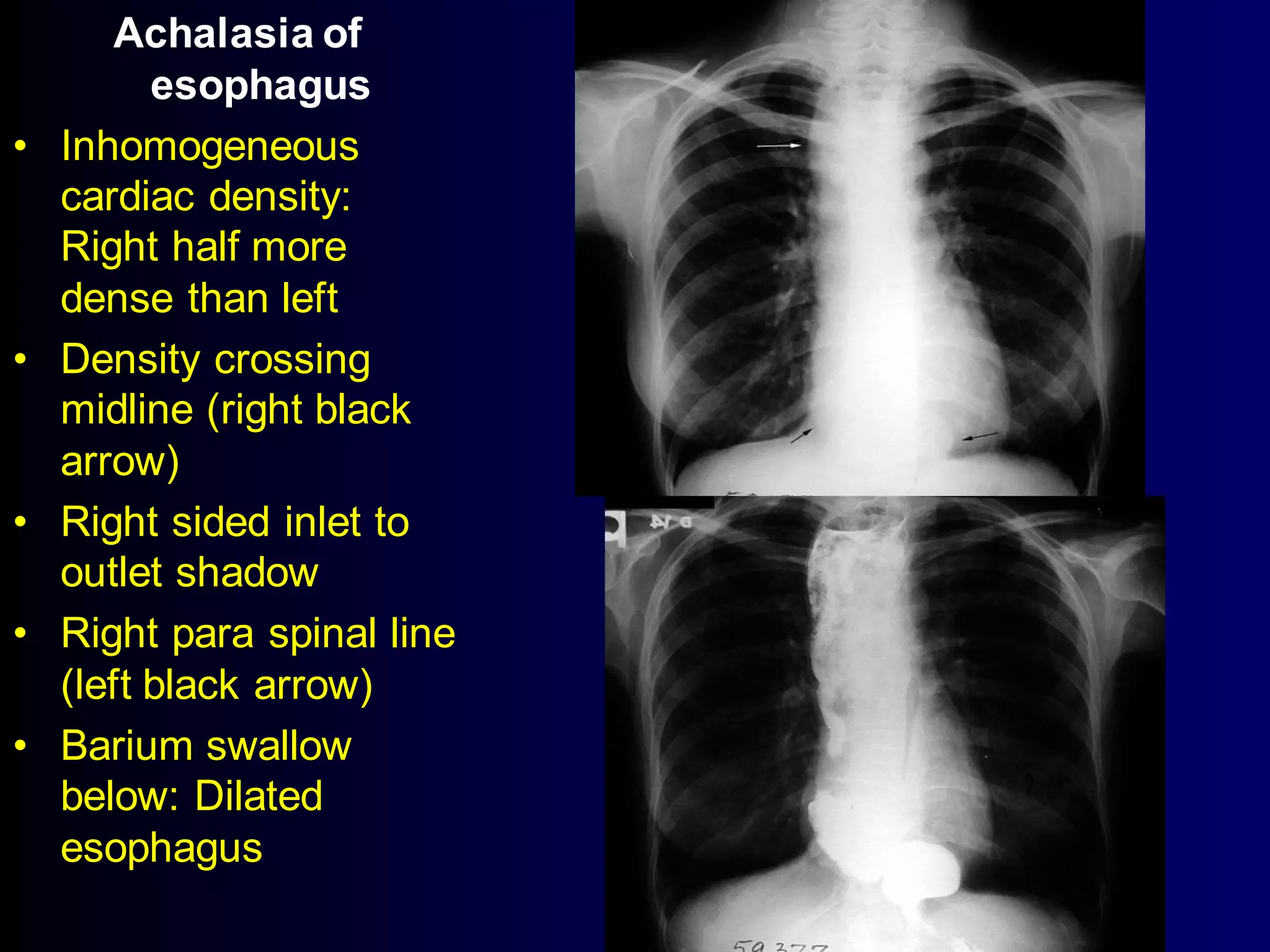 •

•

•
•
•

Achalasia of
esophagus
Inhomogeneous
cardiac density:
Right half more
dense than left
Density crossing
midline (right black
arrow)
Right sided inlet to
outlet shadow
Right para spinal line
(left black arrow)
Barium swallow
below: Dilated
esophagus

 