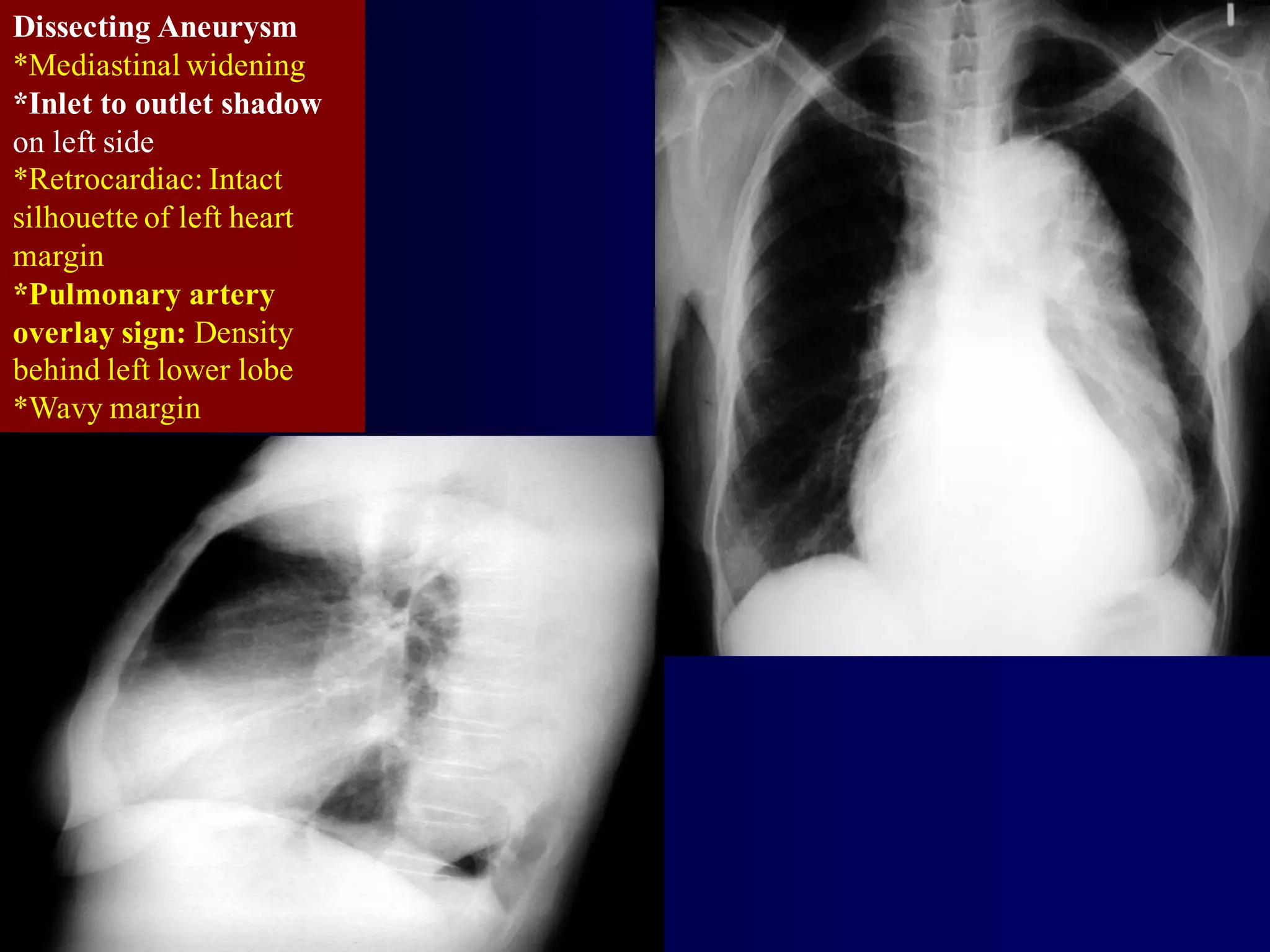 Dissecting Aneurysm
*Mediastinal widening
*Inlet to outlet shadow
on left side
*Retrocardiac: Intact
silhouette of left heart
margin
*Pulmonary artery
overlay sign: Density
behind left lower lobe
*Wavy margin

 