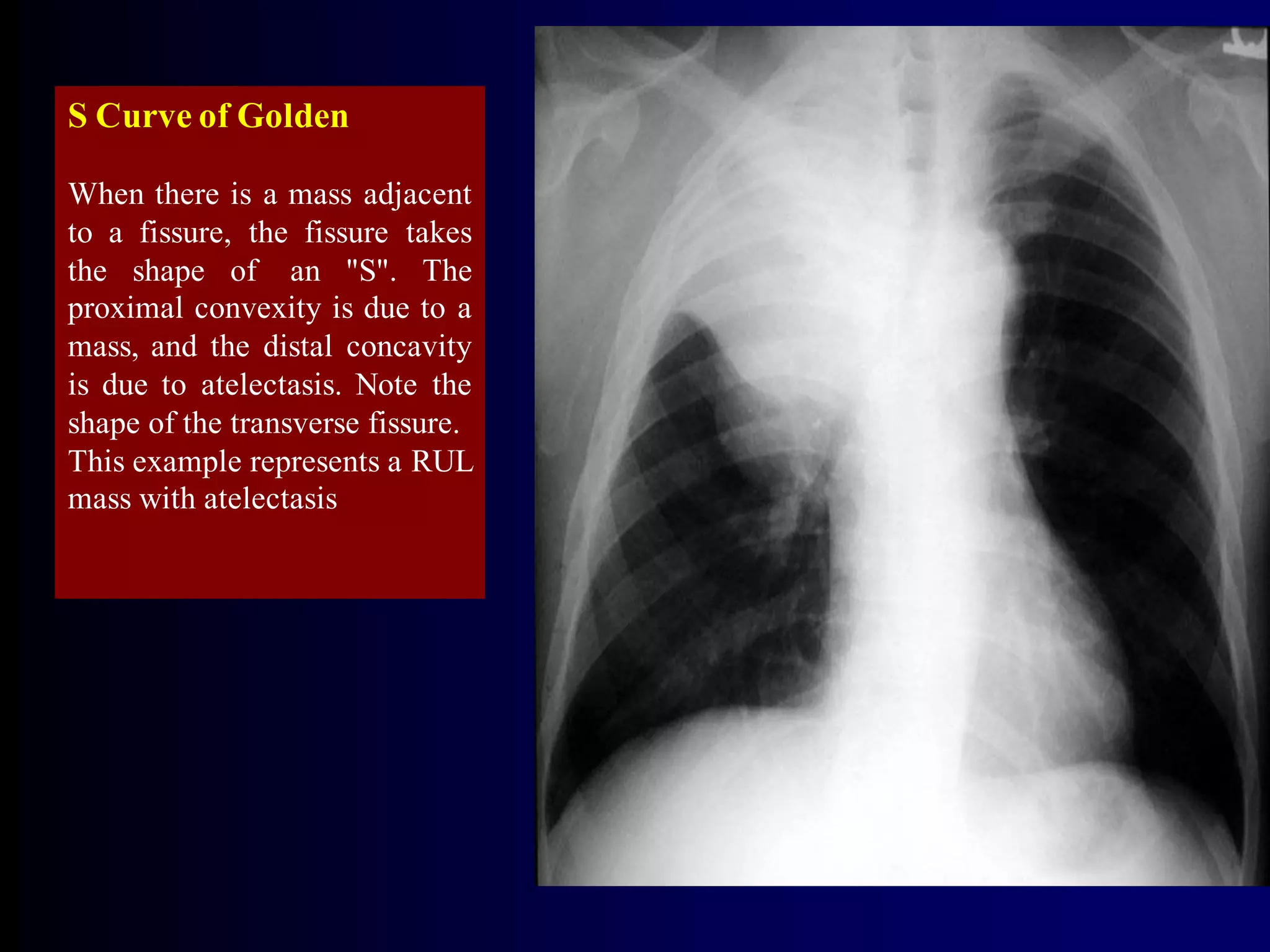 S Curve of Golden
When there is a mass adjacent
to a fissure, the fissure takes
the shape of an "S". The
proximal convexity is due to a
mass, and the distal concavity
is due to atelectasis. Note the
shape of the transverse fissure.
This example represents a RUL
mass with atelectasis

 