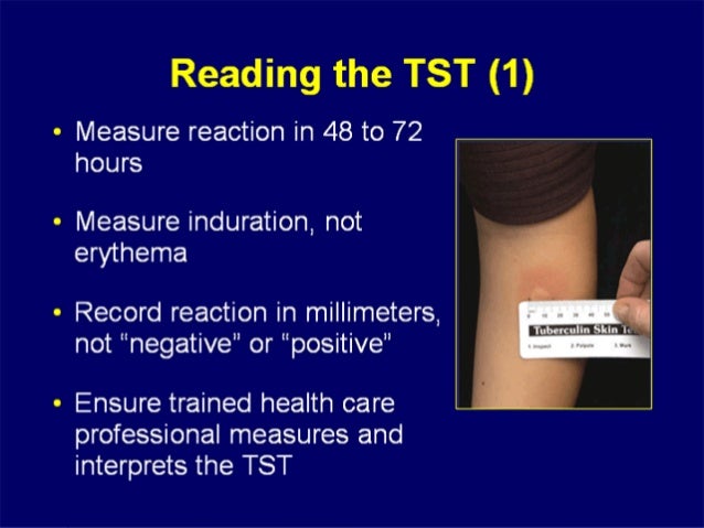 arm negative tb test arm negative tb test