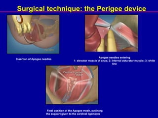 Insertion of Apogee needles Apogee needles entering 1: elevator muscle of anus; 2: internal obturator muscle; 3: white line Final position of the Apogee mesh, outlining the support given to the cardinal ligaments Surgical technique: the Perigee device 