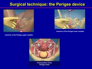 Surgical technique: the Perigee device Insertion of the Perigee upper needles Insertion of the Perigee lower needles Final position of the Perigee mesh 