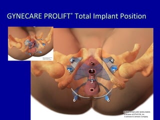 GYNECARE PROLIFT *  Total Implant Position 