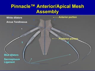 Pinnacle ™  Anterior/Apical Mesh Assembly White dilators Arcus Tendineous Blue dilators Sacrospinous Ligament Anterior portion Posterior portion 3 4 1 2 