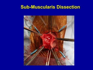 Sub-Muscularis Dissection 