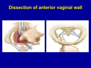 Dissection of anterior vaginal wall 