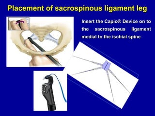 Placement of sacrospinous ligament leg Insert the Capio ®  Device on to the sacrospinous ligament medial to the ischial spine 