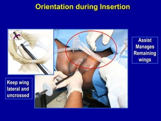 Orientation during Insertion Keep wing lateral and uncrossed Assist Manages Remaining wings 