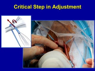 Critical Step in Adjustment 