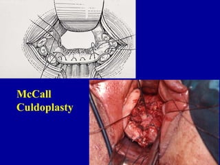 McCall  Culdoplasty 