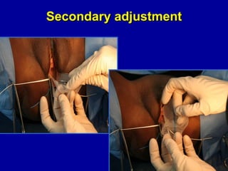 Secondary adjustment 