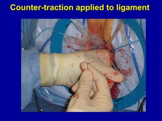 Counter-traction applied to ligament 