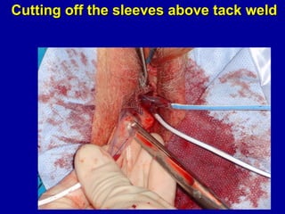 Cutting off the sleeves above tack weld 