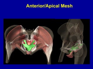 Anterior/Apical Mesh Mesh Placement with Vagina in place  