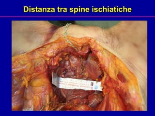 Distanza tra spine ischiatiche 
