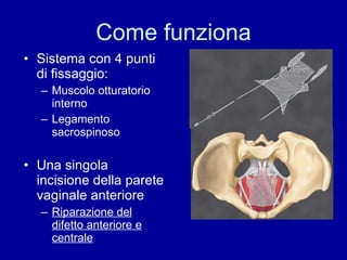 Come funziona Sistema con 4 punti di fissaggio: Muscolo otturatorio interno Legamento sacrospinoso Una singola incisione della parete vaginale anteriore Riparazione del difetto anteriore e centrale 