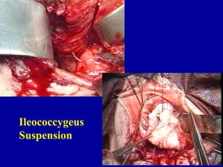 Ileococcygeus  Suspension 