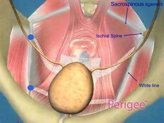 White line Sacrospinous  ligament Ischial Spine 