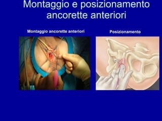 Montaggio e posizionamento ancorette anteriori Montaggio ancorette anteriori Posizionamento 