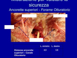 Ancorette Canale Otturatorio Arteria Otturatoria Sinfisi Pubica Misurazione per valutare la sicurezza  Ancorette superiori -  Forame Otturatorio Distanza ancorette superiori – Canale Otturatorio 3.8 4.0 L. destro L. sinistro 