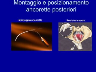 Montaggio ancorette Posizionamento Montaggio e posizionamento ancorette posteriori 