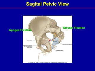 Sagital Pelvic View Apogee Fixation Elevate Fixation 