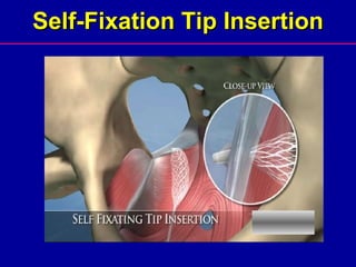 Self-Fixation Tip Insertion 