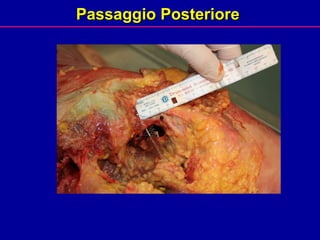 Passaggio Posteriore  