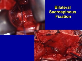 Bilateral  Sacrospinous  Fixation 