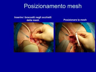 Posizionamento mesh Inserire i braccetti negli occhielli della mesh Posizionare la mesh 