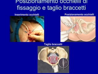 Posizionamento occhielli di fissaggio e taglio braccetti Posizionamento occhielli Inserimento occhielli Taglio braccetti 