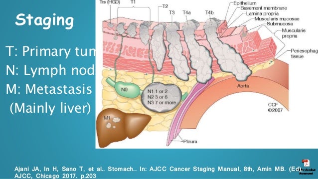 Updated Treatment Of Esophageal Cancer Rapid Clinical Review Updated Treatment Of Esophageal Cancer Rapid Clinical Review