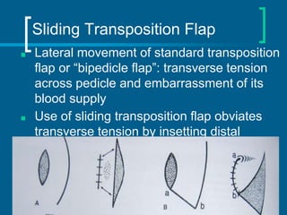 Transposition Vs Rotation Flap Uper n middle third leg defects | PPTX