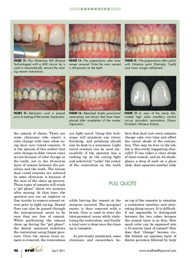Upgrading porcelain veneers