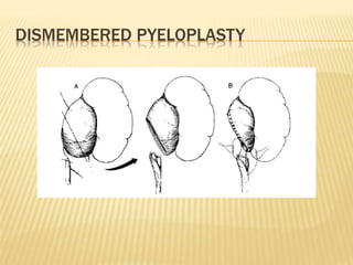 DISMEMBERED PYELOPLASTY
 