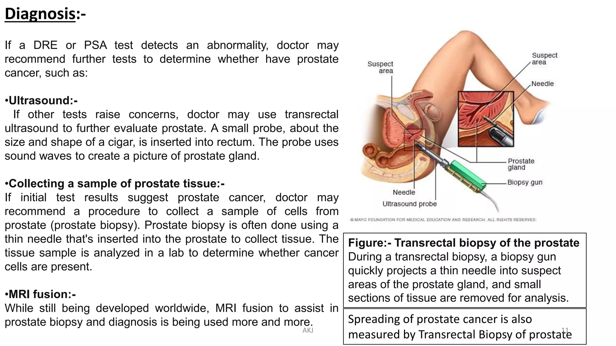 Diagnosis:-
If a DRE or PSA test detects an abnormality, doctor may
recommend further tests to determine whether have prostate
cancer, such as:
•Ultrasound:-
If other tests raise concerns, doctor may use transrectal
ultrasound to further evaluate prostate. A small probe, about the
size and shape of a cigar, is inserted into rectum. The probe uses
sound waves to create a picture of prostate gland.
•Collecting a sample of prostate tissue:-
If initial test results suggest prostate cancer, doctor may
recommend a procedure to collect a sample of cells from
prostate (prostate biopsy). Prostate biopsy is often done using a
thin needle that's inserted into the prostate to collect tissue. The
tissue sample is analyzed in a lab to determine whether cancer
cells are present.
•MRI fusion:-
While still being developed worldwide, MRI fusion to assist in
prostate biopsy and diagnosis is being used more and more.
Figure:- Transrectal biopsy of the prostate
During a transrectal biopsy, a biopsy gun
quickly projects a thin needle into suspect
areas of the prostate gland, and small
sections of tissue are removed for analysis.
Spreading of prostate cancer is also
measured by Transrectal Biopsy of prostateAKJ 11
 