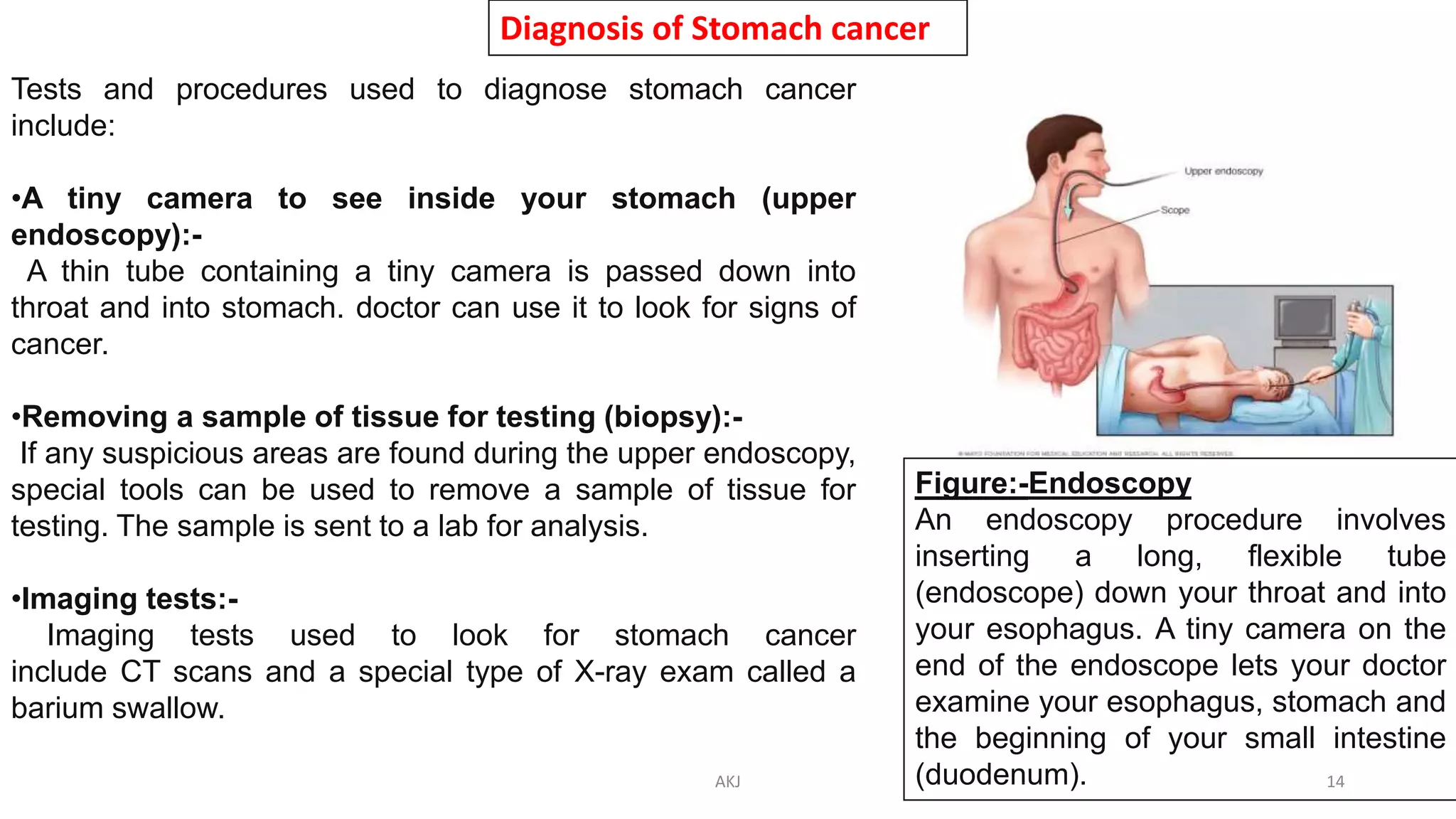 Diagnosis of Stomach cancer
Tests and procedures used to diagnose stomach cancer
include:
•A tiny camera to see inside your stomach (upper
endoscopy):-
A thin tube containing a tiny camera is passed down into
throat and into stomach. doctor can use it to look for signs of
cancer.
•Removing a sample of tissue for testing (biopsy):-
If any suspicious areas are found during the upper endoscopy,
special tools can be used to remove a sample of tissue for
testing. The sample is sent to a lab for analysis.
•Imaging tests:-
Imaging tests used to look for stomach cancer
include CT scans and a special type of X-ray exam called a
barium swallow.
Figure:-Endoscopy
An endoscopy procedure involves
inserting a long, flexible tube
(endoscope) down your throat and into
your esophagus. A tiny camera on the
end of the endoscope lets your doctor
examine your esophagus, stomach and
the beginning of your small intestine
(duodenum).AKJ 14
 