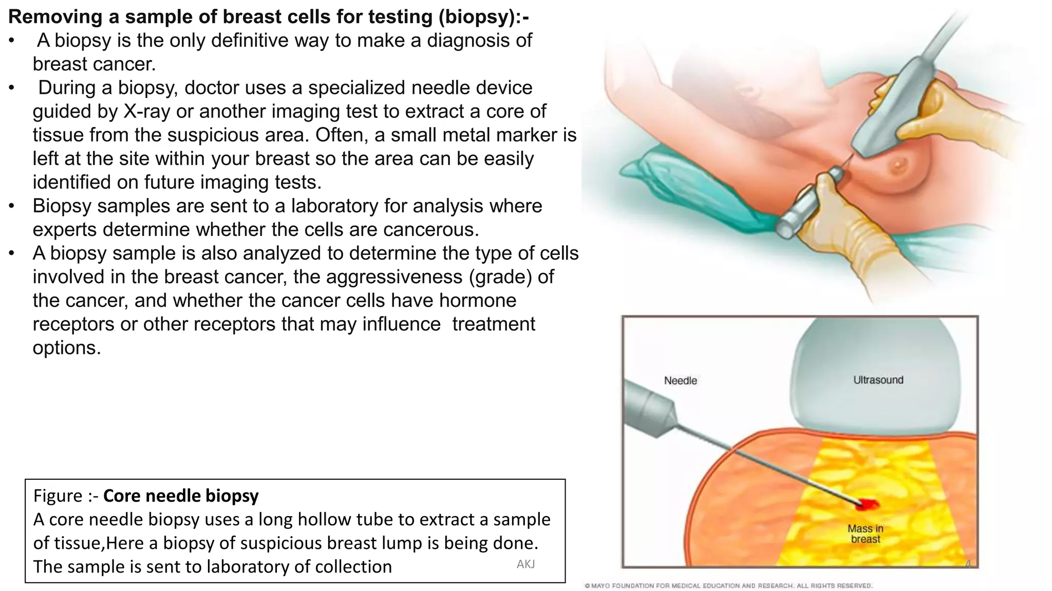 Removing a sample of breast cells for testing (biopsy):-
• A biopsy is the only definitive way to make a diagnosis of
breast cancer.
• During a biopsy, doctor uses a specialized needle device
guided by X-ray or another imaging test to extract a core of
tissue from the suspicious area. Often, a small metal marker is
left at the site within your breast so the area can be easily
identified on future imaging tests.
• Biopsy samples are sent to a laboratory for analysis where
experts determine whether the cells are cancerous.
• A biopsy sample is also analyzed to determine the type of cells
involved in the breast cancer, the aggressiveness (grade) of
the cancer, and whether the cancer cells have hormone
receptors or other receptors that may influence treatment
options.
Figure :- Core needle biopsy
A core needle biopsy uses a long hollow tube to extract a sample
of tissue,Here a biopsy of suspicious breast lump is being done.
The sample is sent to laboratory of collection AKJ 4
 