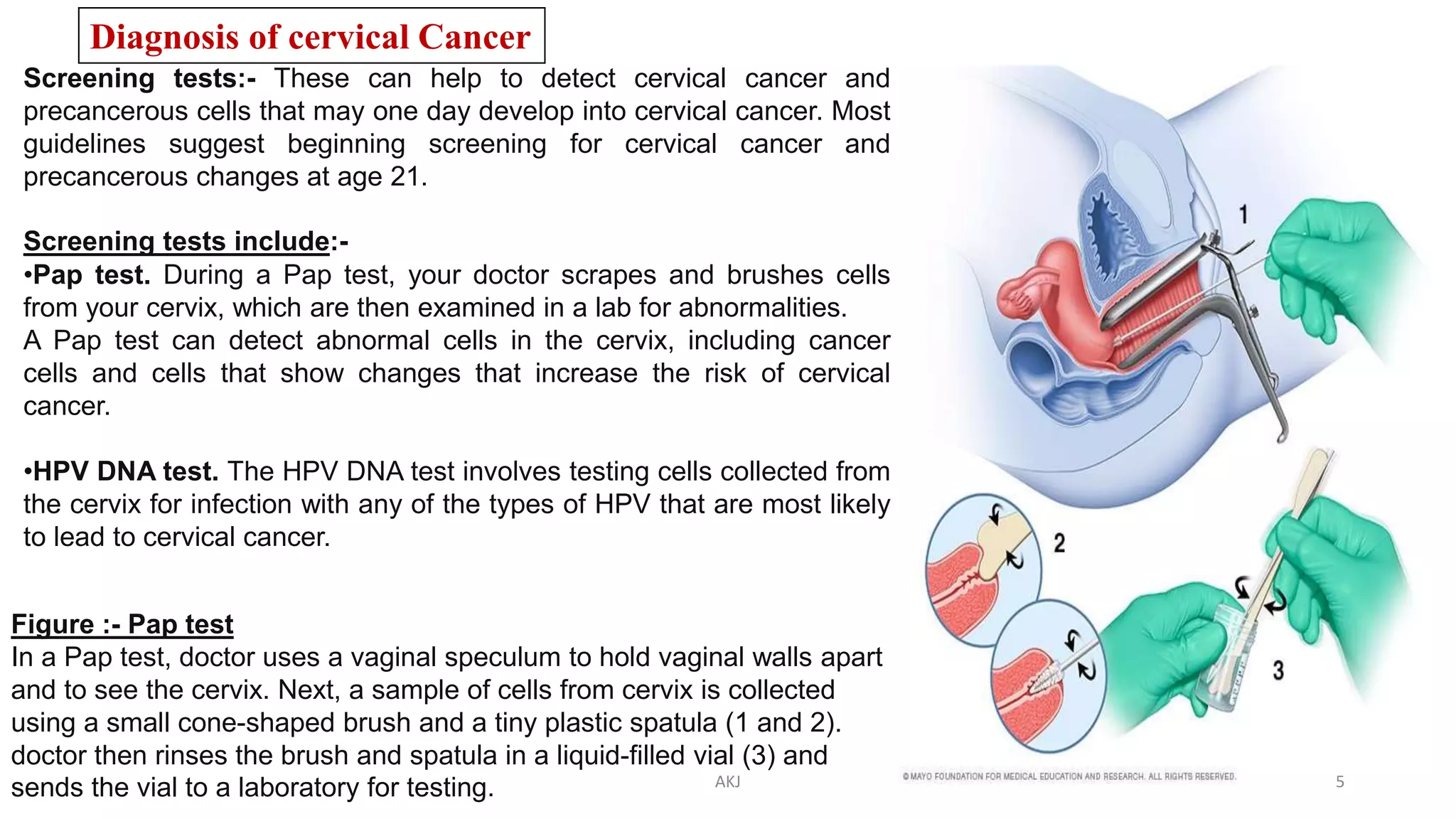Diagnosis of cervical Cancer
Screening tests:- These can help to detect cervical cancer and
precancerous cells that may one day develop into cervical cancer. Most
guidelines suggest beginning screening for cervical cancer and
precancerous changes at age 21.
Screening tests include:-
•Pap test. During a Pap test, your doctor scrapes and brushes cells
from your cervix, which are then examined in a lab for abnormalities.
A Pap test can detect abnormal cells in the cervix, including cancer
cells and cells that show changes that increase the risk of cervical
cancer.
•HPV DNA test. The HPV DNA test involves testing cells collected from
the cervix for infection with any of the types of HPV that are most likely
to lead to cervical cancer.
Figure :- Pap test
In a Pap test, doctor uses a vaginal speculum to hold vaginal walls apart
and to see the cervix. Next, a sample of cells from cervix is collected
using a small cone-shaped brush and a tiny plastic spatula (1 and 2).
doctor then rinses the brush and spatula in a liquid-filled vial (3) and
sends the vial to a laboratory for testing. AKJ 5
 