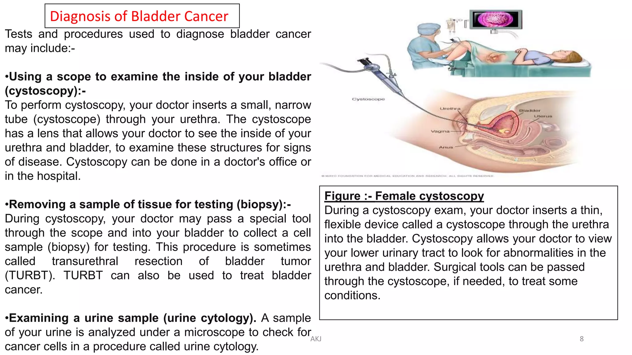 Diagnosis of Bladder Cancer
Tests and procedures used to diagnose bladder cancer
may include:-
•Using a scope to examine the inside of your bladder
(cystoscopy):-
To perform cystoscopy, your doctor inserts a small, narrow
tube (cystoscope) through your urethra. The cystoscope
has a lens that allows your doctor to see the inside of your
urethra and bladder, to examine these structures for signs
of disease. Cystoscopy can be done in a doctor's office or
in the hospital.
•Removing a sample of tissue for testing (biopsy):-
During cystoscopy, your doctor may pass a special tool
through the scope and into your bladder to collect a cell
sample (biopsy) for testing. This procedure is sometimes
called transurethral resection of bladder tumor
(TURBT). TURBT can also be used to treat bladder
cancer.
•Examining a urine sample (urine cytology). A sample
of your urine is analyzed under a microscope to check for
cancer cells in a procedure called urine cytology.
Figure :- Female cystoscopy
During a cystoscopy exam, your doctor inserts a thin,
flexible device called a cystoscope through the urethra
into the bladder. Cystoscopy allows your doctor to view
your lower urinary tract to look for abnormalities in the
urethra and bladder. Surgical tools can be passed
through the cystoscope, if needed, to treat some
conditions.
AKJ 8
 