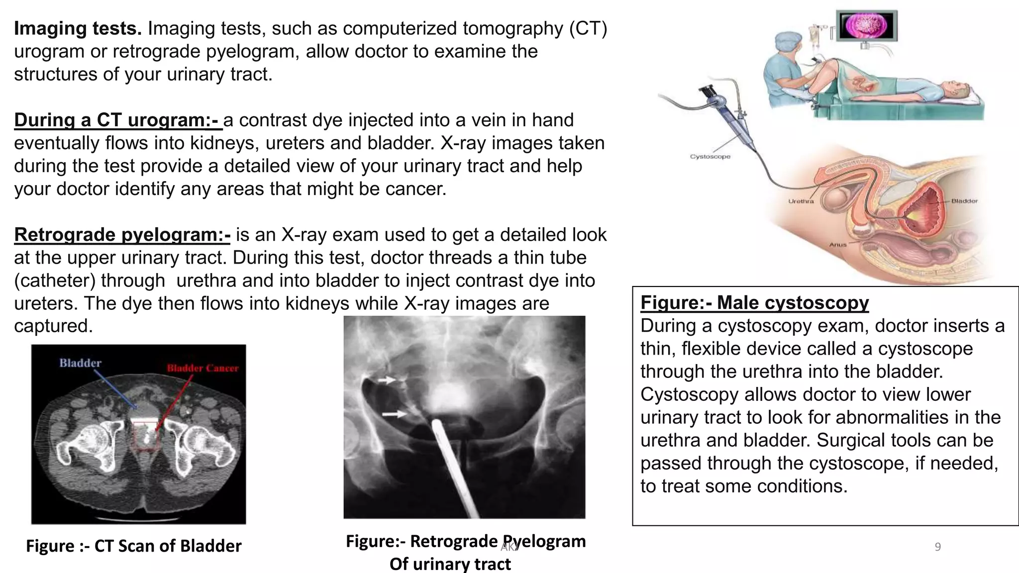 Figure:- Male cystoscopy
During a cystoscopy exam, doctor inserts a
thin, flexible device called a cystoscope
through the urethra into the bladder.
Cystoscopy allows doctor to view lower
urinary tract to look for abnormalities in the
urethra and bladder. Surgical tools can be
passed through the cystoscope, if needed,
to treat some conditions.
Imaging tests. Imaging tests, such as computerized tomography (CT)
urogram or retrograde pyelogram, allow doctor to examine the
structures of your urinary tract.
During a CT urogram:- a contrast dye injected into a vein in hand
eventually flows into kidneys, ureters and bladder. X-ray images taken
during the test provide a detailed view of your urinary tract and help
your doctor identify any areas that might be cancer.
Retrograde pyelogram:- is an X-ray exam used to get a detailed look
at the upper urinary tract. During this test, doctor threads a thin tube
(catheter) through urethra and into bladder to inject contrast dye into
ureters. The dye then flows into kidneys while X-ray images are
captured.
Figure :- CT Scan of Bladder Figure:- Retrograde Pyelogram
Of urinary tract
AKJ 9
 